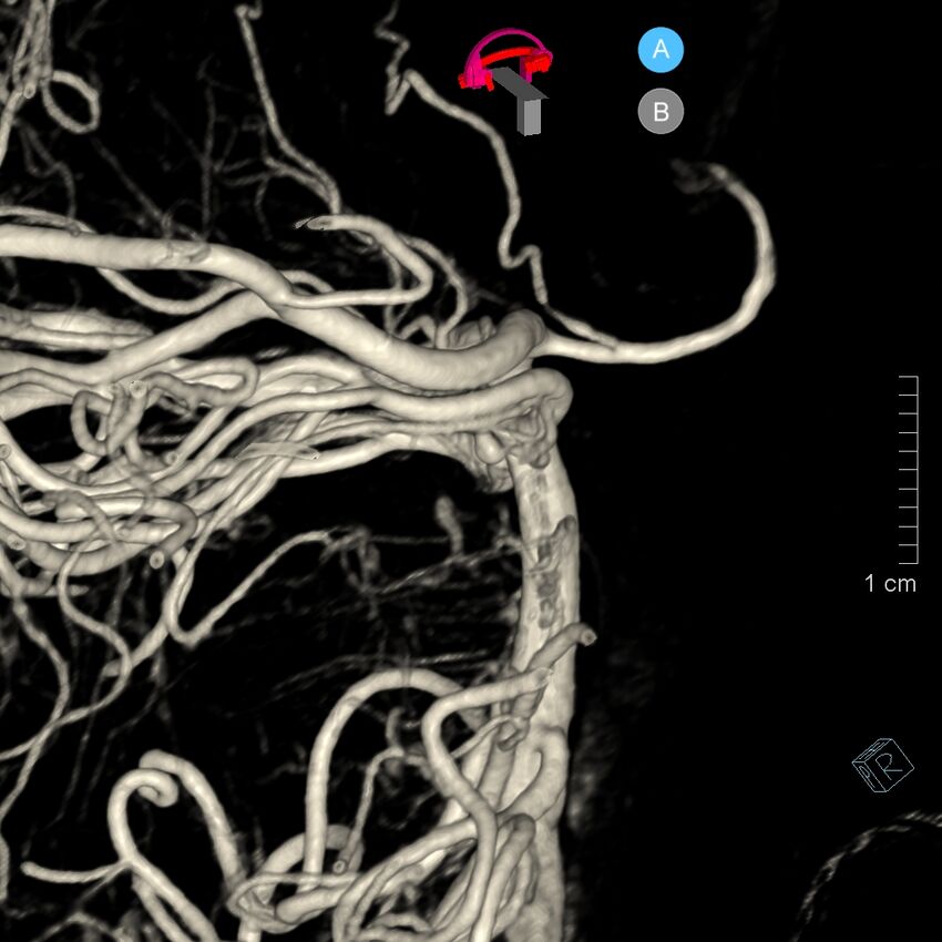 Basilar artery perforator aneurysm (Radiopaedia 82455-97734 3D view left VA 141).jpg