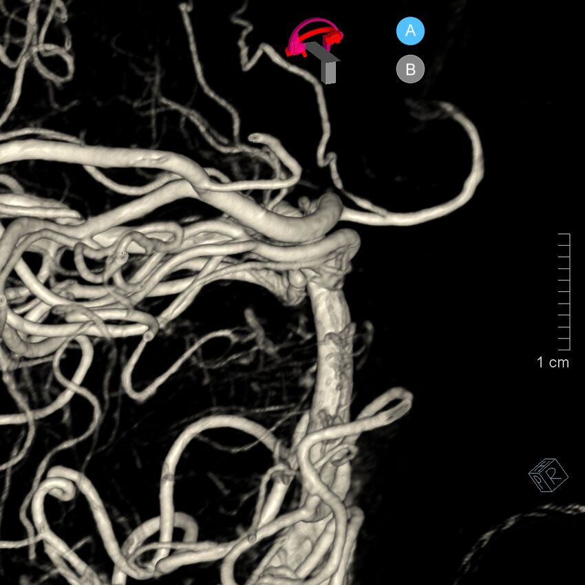 Basilar artery perforator aneurysm (Radiopaedia 82455-97734 3D view left VA 143).jpg