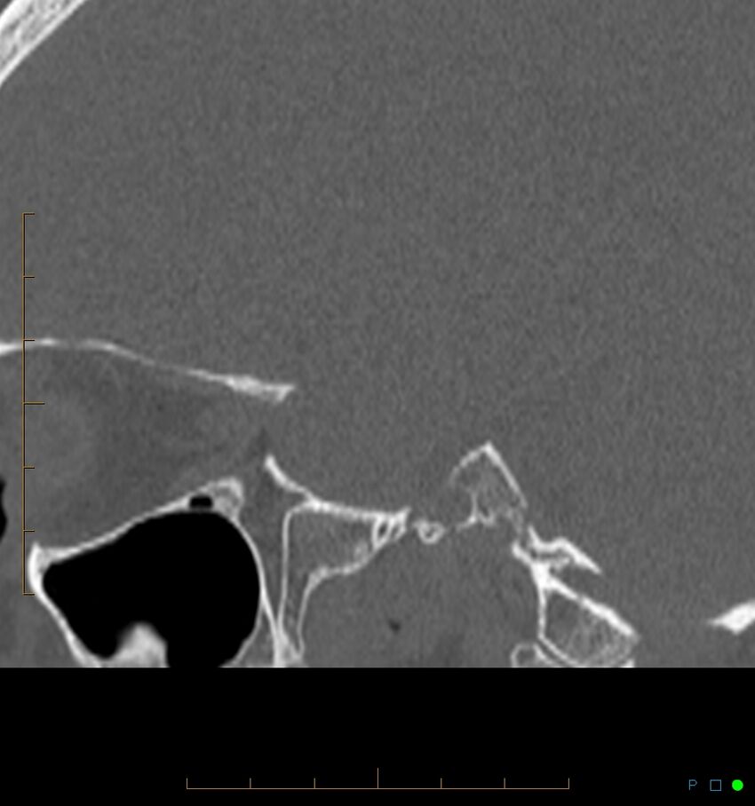 Benign notochordal cell tumor (probable) (Radiopaedia 65475-74546 Sagittal bone window 45).jpg