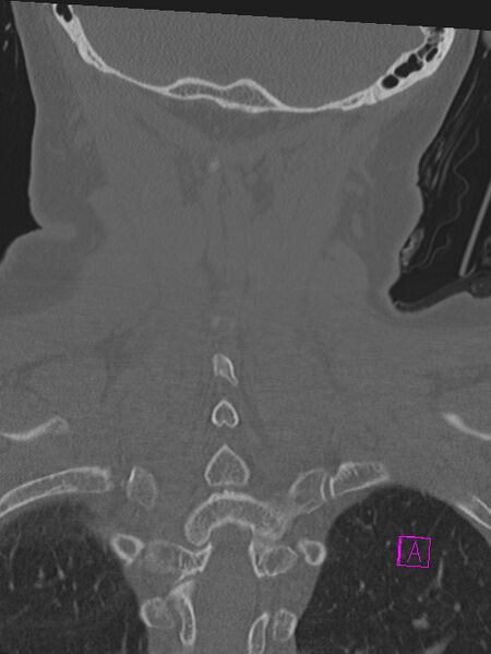 File:Bilateral atlanto-occipital assimilation (Radiopaedia 28350-28603 Coronal bone window 40).jpg