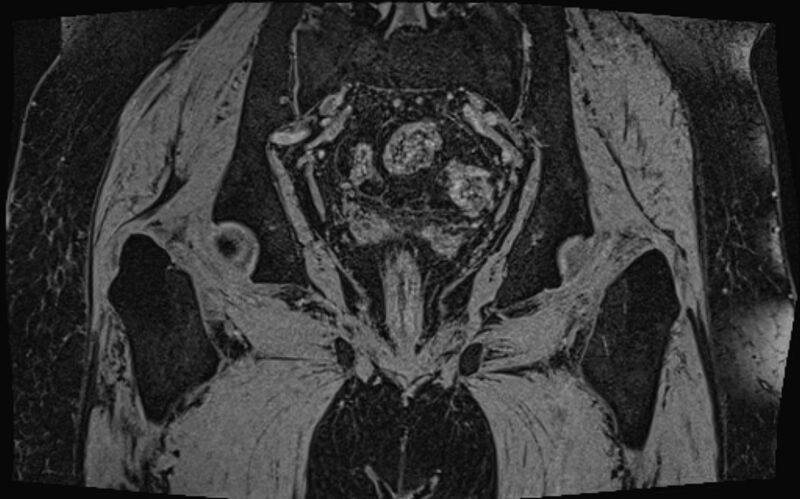 File:Bilateral avascular necrosis of femoral head (Radiopaedia 77116-89078 Coronal T2 we 13).jpg