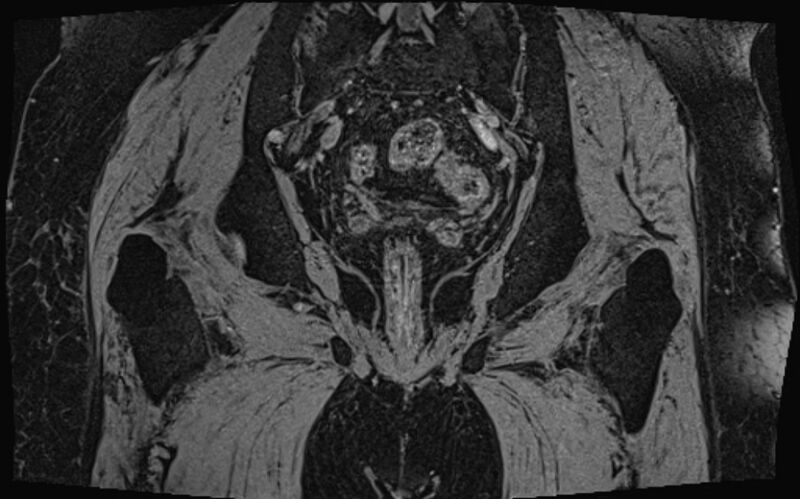 File:Bilateral avascular necrosis of femoral head (Radiopaedia 77116-89078 Coronal T2 we 9).jpg