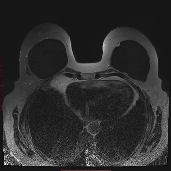 File:Bilateral breast implant rupture (Radiopaedia 24761-25027 T2 fat sat 25).jpg