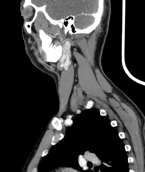 File:Bilateral carotid body tumors (Radiopaedia 52899-58827 C 46).jpg