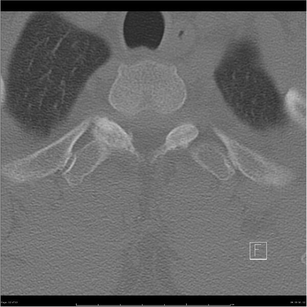File:Bilateral cervical ribs (Radiopaedia 25868-26017 Axial bone window 52).jpg