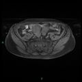 Bilateral ovarian fibroma (Radiopaedia 44568-48293 Axial T1 fat sat 6).jpg