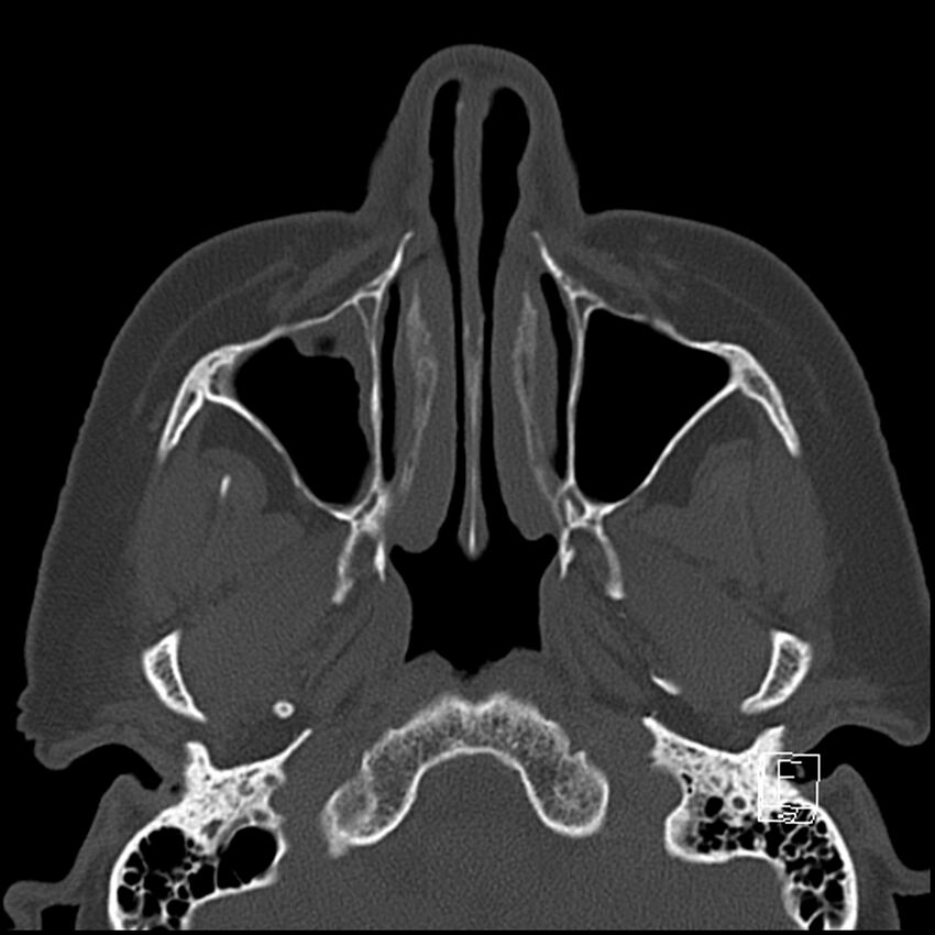 Bilateral palatine tonsilloliths on OPG and CT (Radiopaedia 75167-86247 Axial bone window 23).jpg
