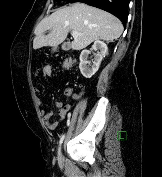 File:Bilateral sporadic synchronous clear cell renal cell carcinoma (Radiopaedia 85035-100575 G 78).jpg