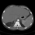 Biliary necrosis - liver transplant (Radiopaedia 21876-21846 A 14).jpg