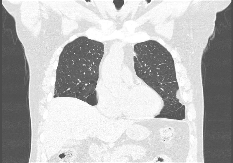 File:Birt-Hogg-Dubé syndrome (Radiopaedia 52578-58491 Coronal lung window 15).jpg