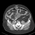 Bladder papillary urothelial carcinoma (Radiopaedia 48119-52951 Axial 40).png