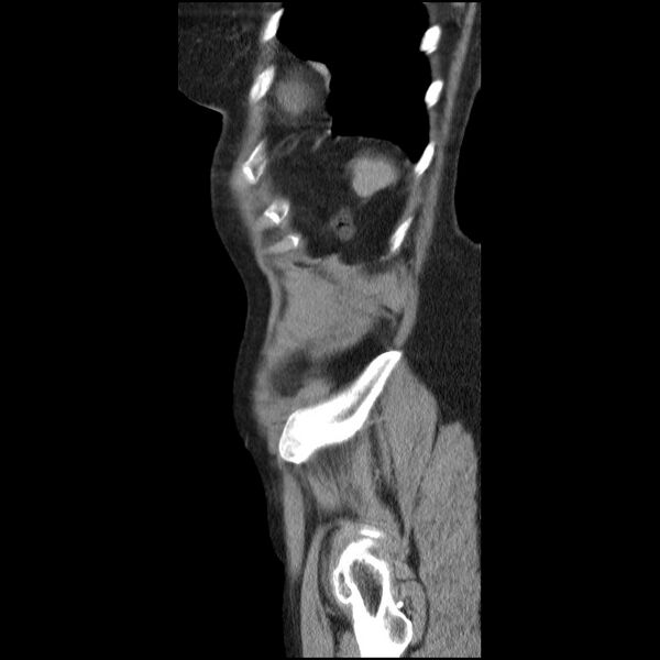 File:Bladder tumor detected on trauma CT (Radiopaedia 51809-57609 E 11).jpg