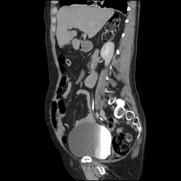 File:Bladder tumor detected on trauma CT (Radiopaedia 51809-57609 E 46).jpg