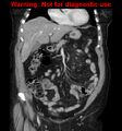 Bosniak renal cyst - type II (Radiopaedia 23404-23468 E 15).jpg