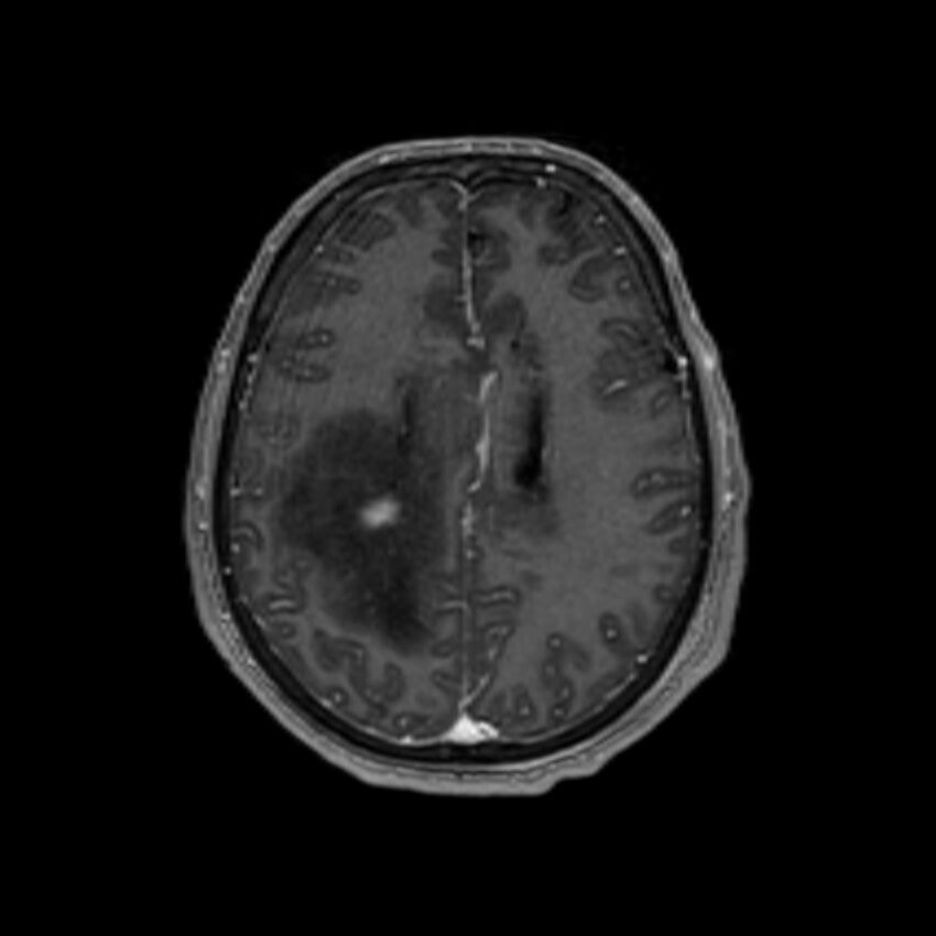 Brain abscess complicated by intraventricular rupture and ventriculitis (Radiopaedia 82434-96577 Axial T1 C+ 47).jpg