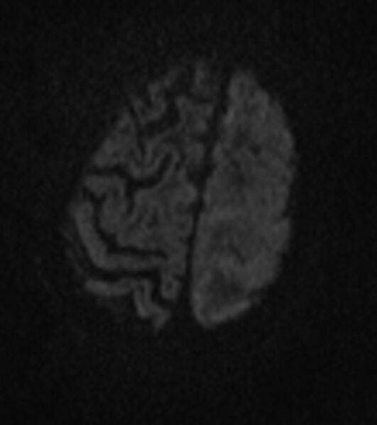 File:Brain abscess with dual rim sign (Radiopaedia 87566-103938 Axial DWI 17).jpg