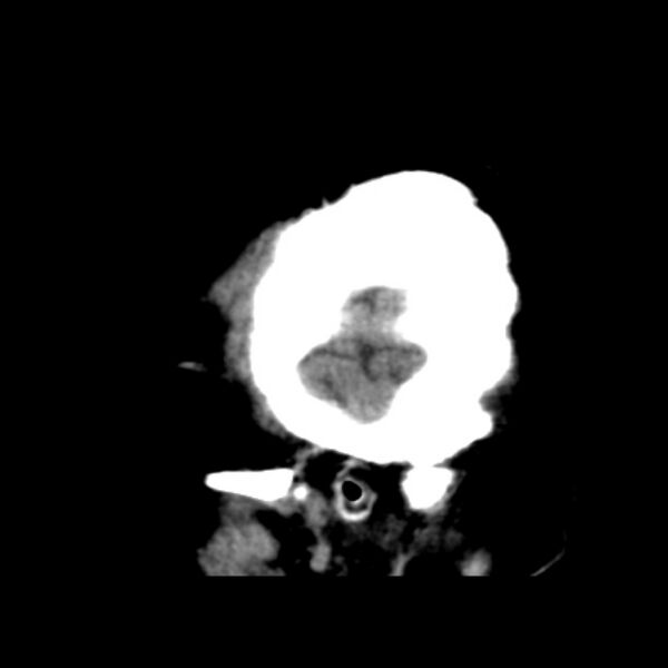 File:Brain cortical laminar necrosis (Radiopaedia 25822-25971 non-contrast 5).jpg