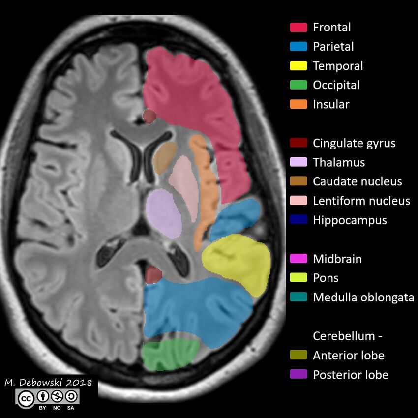 Brain lobes - annotated MRI (Radiopaedia 61691-69700 Axial 33).JPG