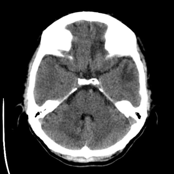 File:Brain metastases from lung cancer (Radiopaedia 24480-24781 Axial non-contrast 12).jpg