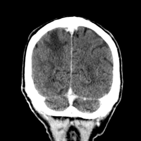 File:Brain metastases from lung cancer (Radiopaedia 27849-28092 Coronal C+ delayed 56).jpg