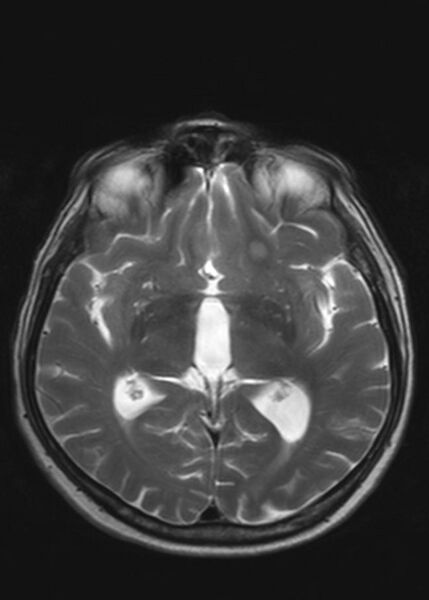 File:Brain metastases from squamocellular lung cancer (Radiopaedia 56515-63222 Axial T2 13).jpg
