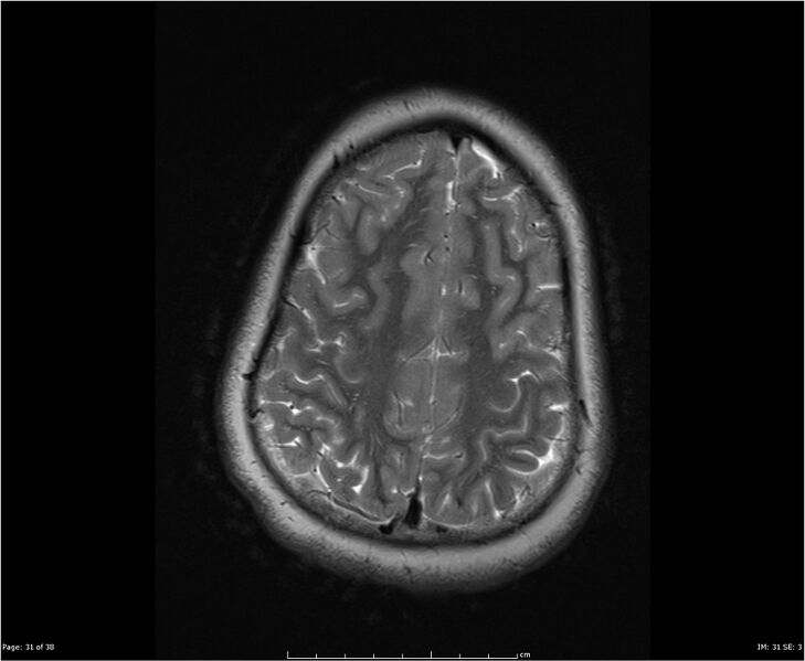 File:Brainstem glioma (Radiopaedia 21819-21775 Axial T2 31).jpg
