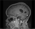 Brainstem glioma (Radiopaedia 21819-21775 D 15).jpg