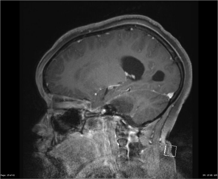 File:Brainstem glioma (Radiopaedia 21819-21775 D 15).jpg