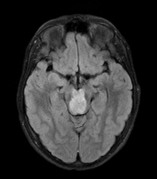 File:Brainstem glioma - focal midbrain (Radiopaedia 6525-7840 Axial FLAIR 1).jpg