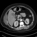 Breast carcinoma with pathological hip fracture (Radiopaedia 60314-67974 A 56).jpg