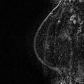 Breast implants - MRI (Radiopaedia 26864-27035 Sagittal T2 7).jpg