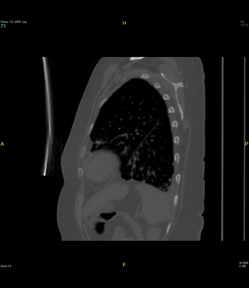 Breast primary with lung and bone metastases (Radiopaedia 40620-43228 Sagittal bone window 71).jpg