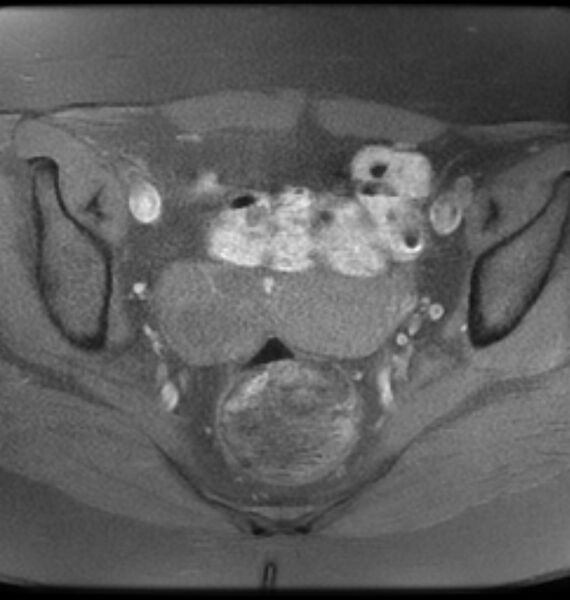 File:Broad ligament leiomyoma (Radiopaedia 81634-95516 Axial T1 fat sat 13).jpg