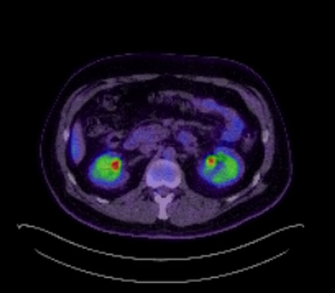 File:Bronchial carcinoid tumor (Radiopaedia 67377-76766 18FDG-PET-CT 43).jpg