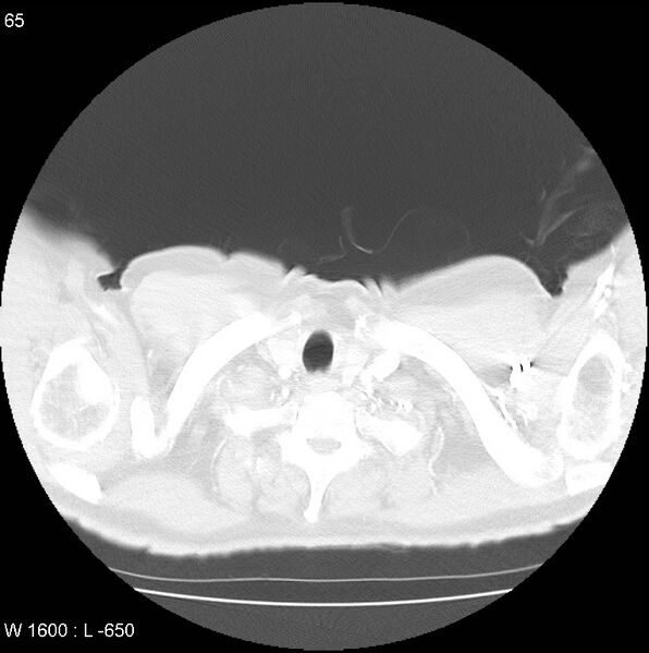 File:Bronchial carcinoid tumor with right lower lobe collapse (Radiopaedia 29060-29422 B 3).jpg