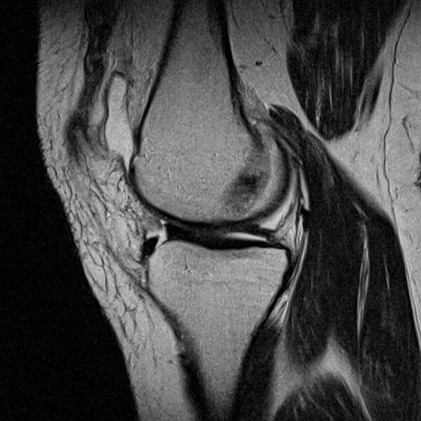 File:Bucket handle tear - medial meniscus (Radiopaedia 79028-91942 Sagittal T2 16).jpg