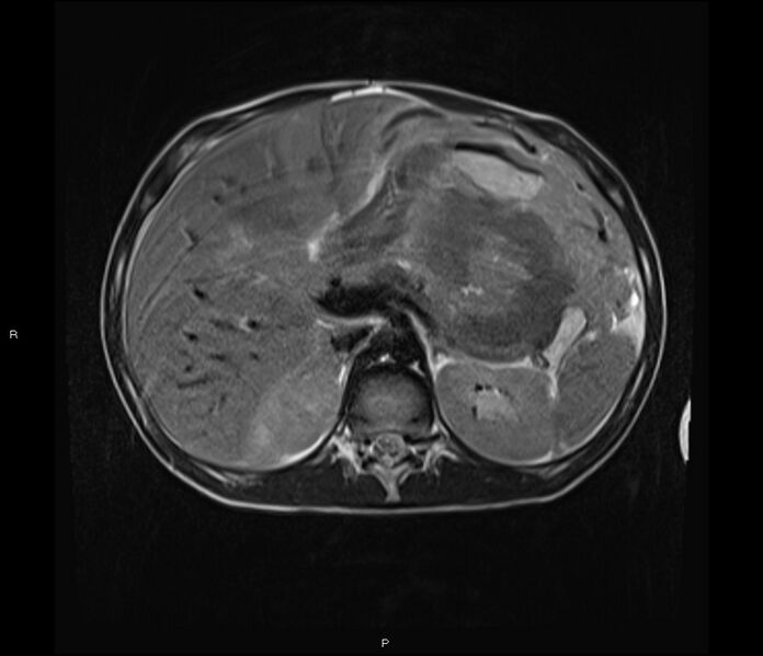File:Burkitt lymphoma (bowel) (Radiopaedia 68839-78557 Axial T2 18).jpg