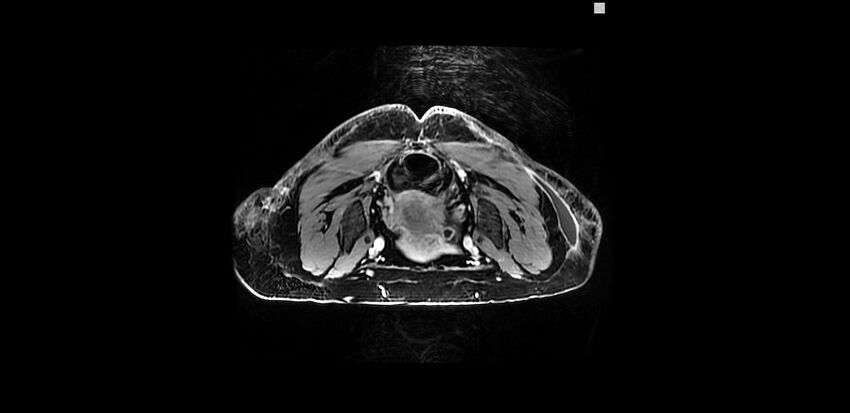 Buttock filler complications (Radiopaedia 63497-72115 Axial T1 C+ 16).jpg