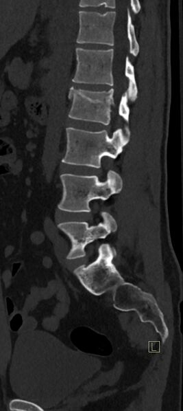 File:Calcaneal fractures with associated L2 burst fracture (Radiopaedia 71671-82493 Sagittal bone window 26).jpg