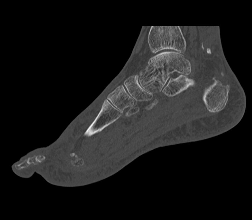 Calcaneal tuberosity avulsion fracture (Radiopaedia 22649-22668 Sagittal bone window 29).jpg