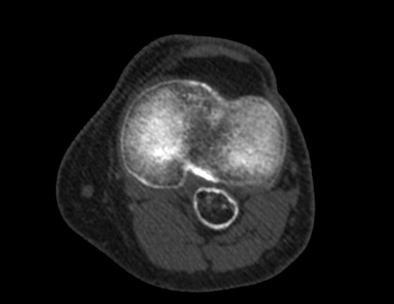 File:Calcified hematoma - popliteal fossa (Radiopaedia 63938-72763 Axial bone window 35).jpg