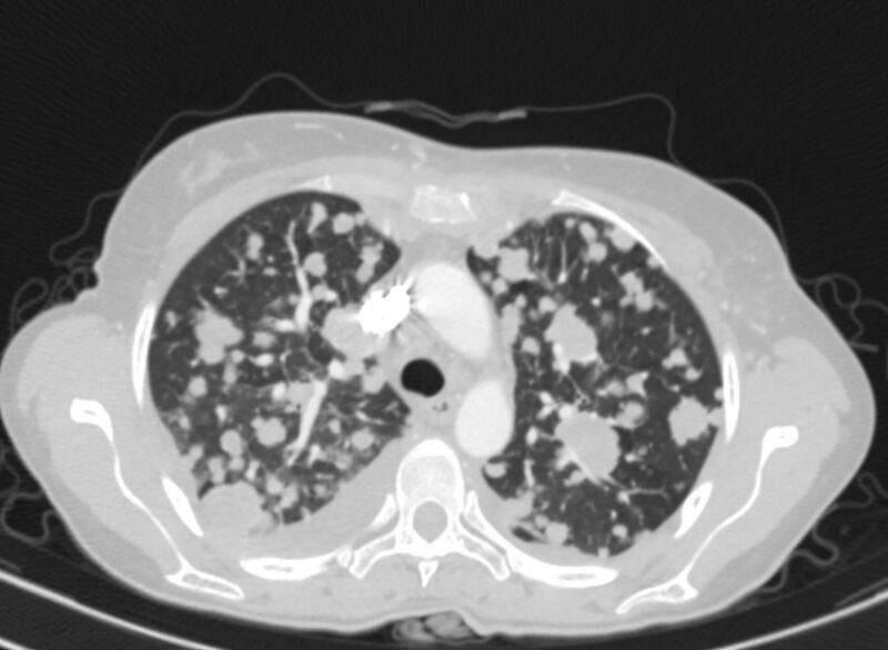 File:Cannonball metastases from breast cancer (Radiopaedia 91024-108569 Axial lung window 27).jpg