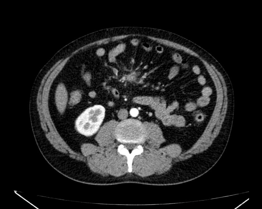 Carcinoid tumor with hepatic metastases (Radiopaedia 22651-22670 B 48).jpg
