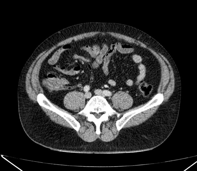 File:Carcinoid tumor with hepatic metastases (Radiopaedia 22651-22670 C 59).jpg