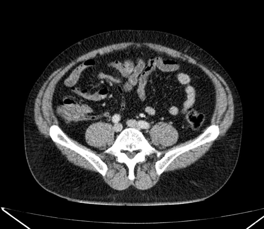 Carcinoid tumor with hepatic metastases (Radiopaedia 22651-22670 C 59).jpg