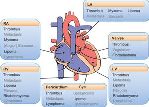 Cardiac masses.png