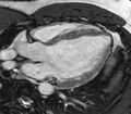 Cardiac sarcoidosis (Radiopaedia 39811-42243 LVOT cine images 2).jpg
