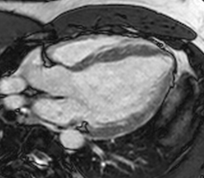 File:Cardiac sarcoidosis (Radiopaedia 39811-42243 LVOT cine images 2).jpg
