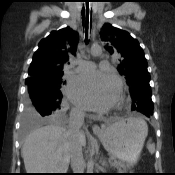 File:Cardiogenic pulmonary edema (Radiopaedia 29213-29609 Coronal non-contrast 20).jpg
