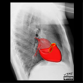 Cardiomediastinal anatomy on chest radiography (annotated images) (Radiopaedia 46331-50748 K 1).png